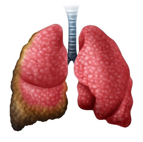 pleural fluid test for mesothelioma